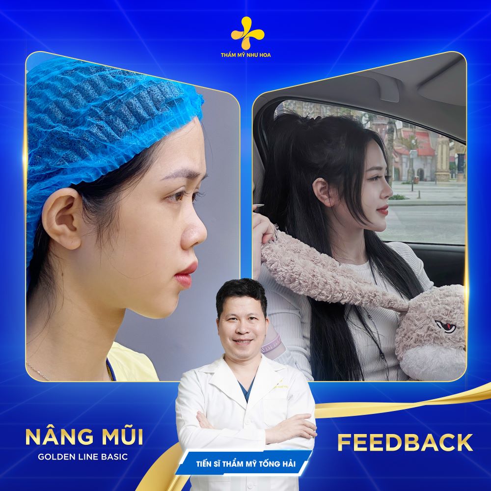Nâng mũi Golden Line Basic