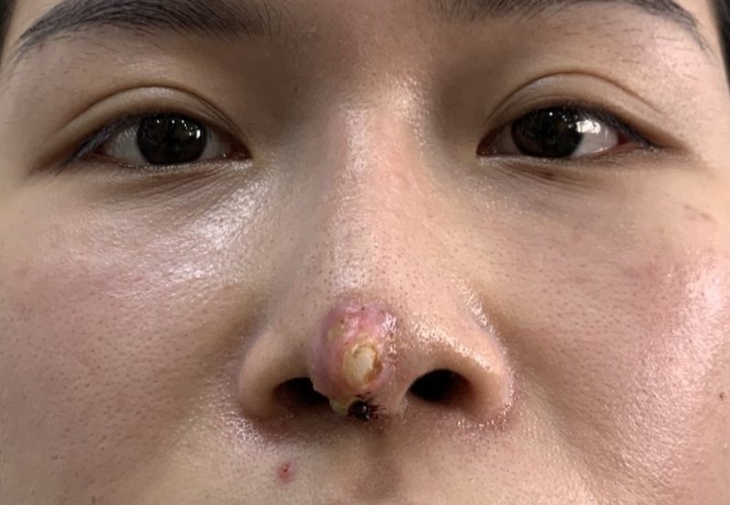 Cần rút sụn mũi khi mũi lộ chất liệu sụn