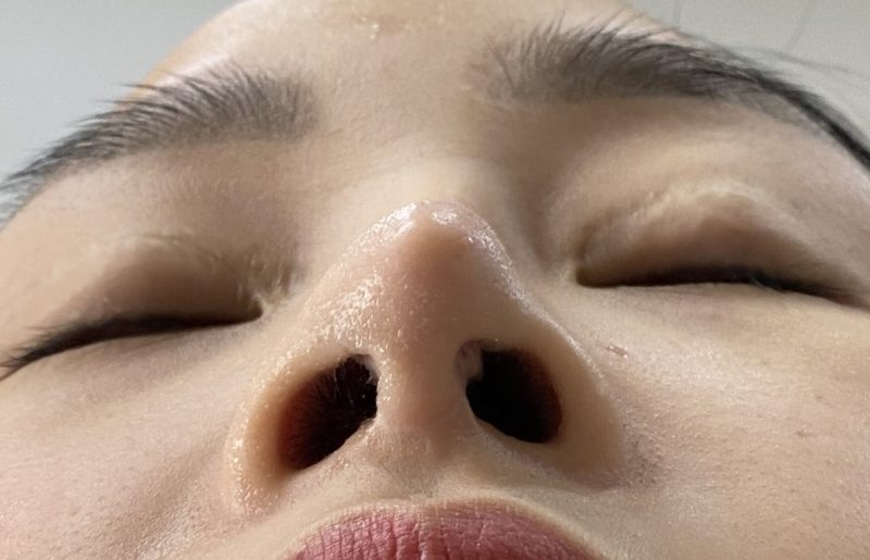 Rút sụn mũi khi mũi bị va đập