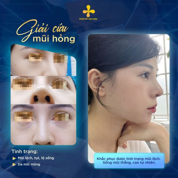 Sau khoảng 6 tháng đến 1 năm rút sụn có thể tái nâng mũi