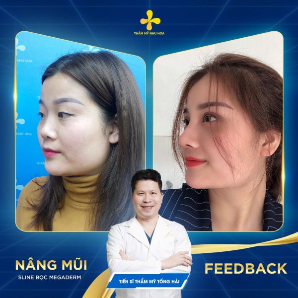Nâng mũi S Line bọc sụn Megaderm