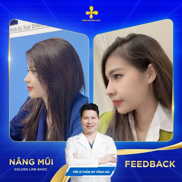 Nâng mũi Golden Line Basic sử dụng sụn Megaderm