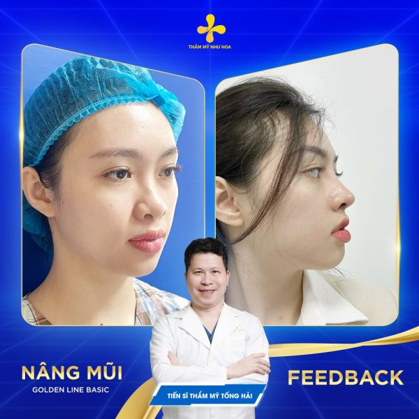 Chất liệu Megaderm an toàn giúp giảm thiểu biến chứng sau nâng mũi 