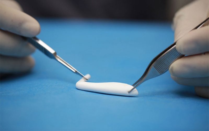 Sử dụng sụn Softxil trong nâng mũi S Line bọc Megaderm