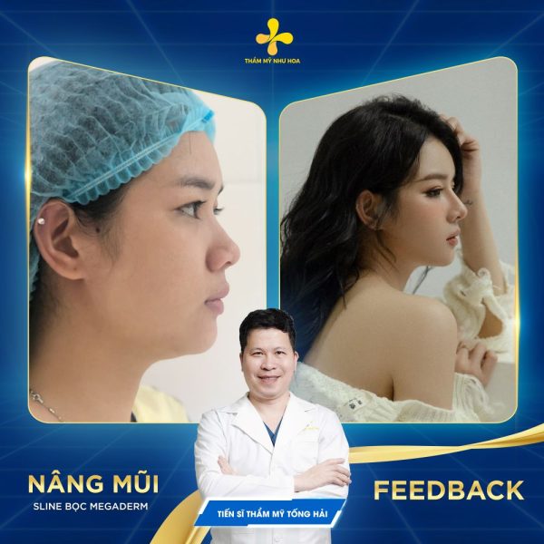 Nâng mũi S Line bọc Megaderm 