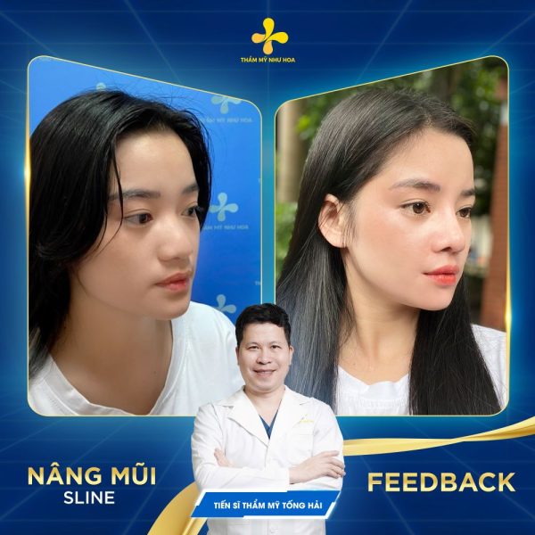 Nâng mũi S Line