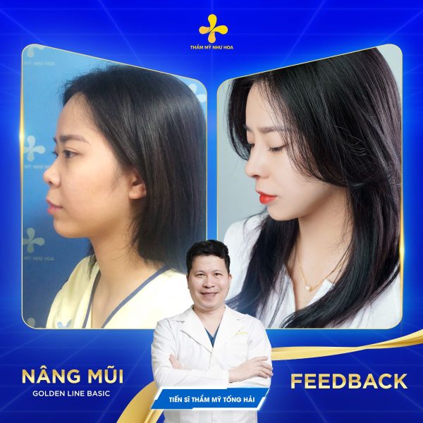 Trước và sau nâng mũi của nữ