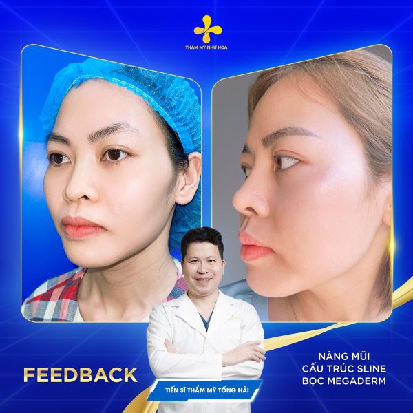Phương pháp nâng mũi cấu trúc S Line bọc Megaderm