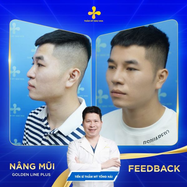 Cảm giác sau phẫu thuật Golden line Plus