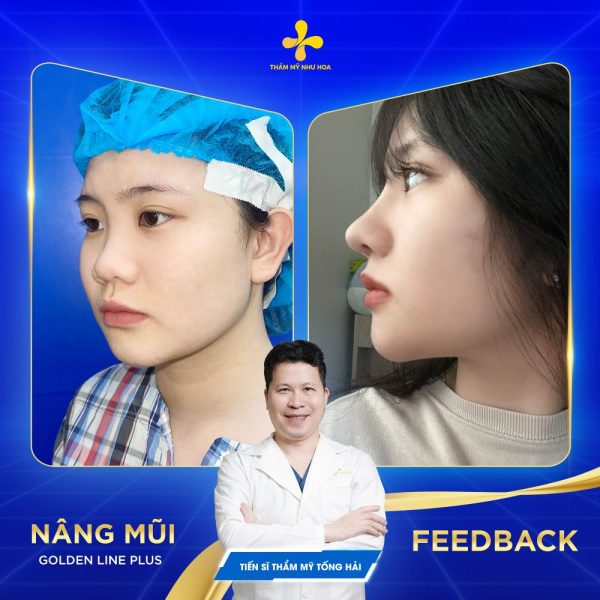 Sau phẫu thuật gói Golden Line Plus