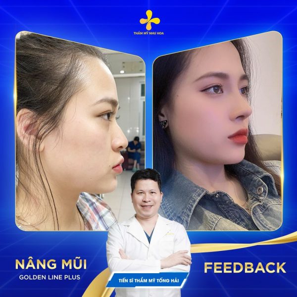 Giới thiệu phương pháp nâng mũi Golden Line Plus