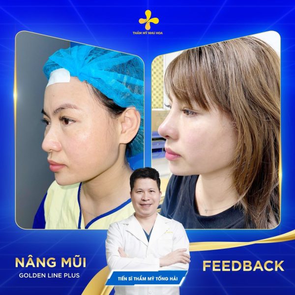 Thời gian phục hồi và các lưu ý cần thiết