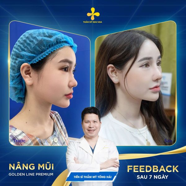 Hình ảnh khách hàng trước và sau khi nâng mũi Golden Line Premium