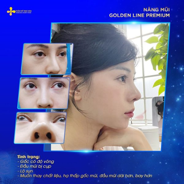 Chi phí nâng mũi Golden Line Premium