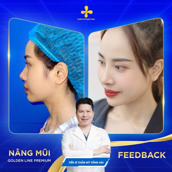 Hình ảnh khách hàng trước và sau khi nâng mũi Golden Line Premium