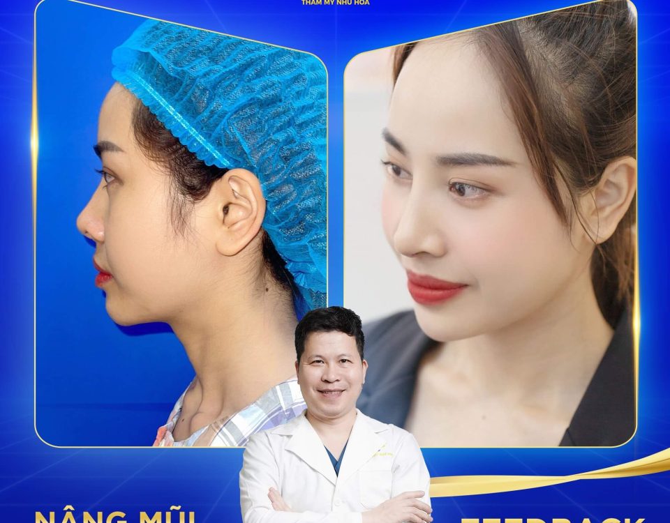 Nâng mũi Golden Line Premium