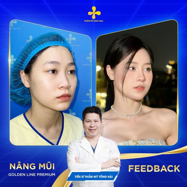 Khách hàng nâng mũi Golden Line Premium