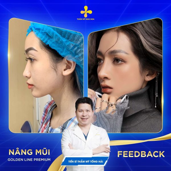Hình ảnh khách hàng trước và sau khi nâng mũi Golden Line Premium