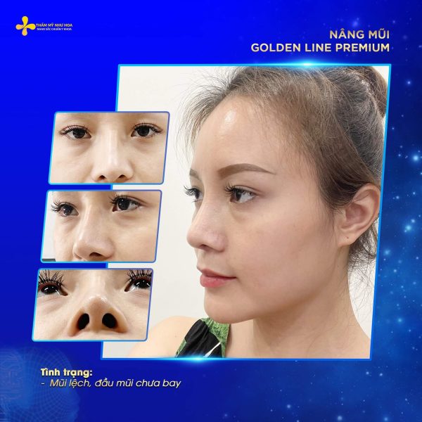 Hình ảnh khách hàng trước và sau khi nâng mũi Golden Line Premium
