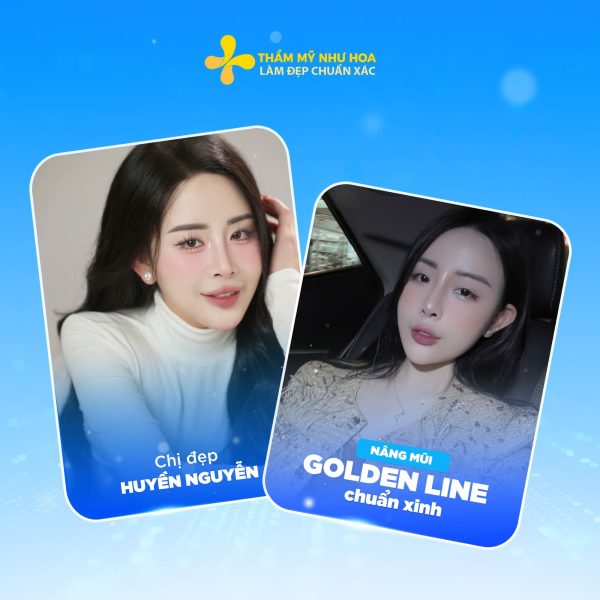 Nâng mũi Golden Line: Công nghệ đỉnh cao cho dáng mũi chuẩn 8 huyen nguyen 1