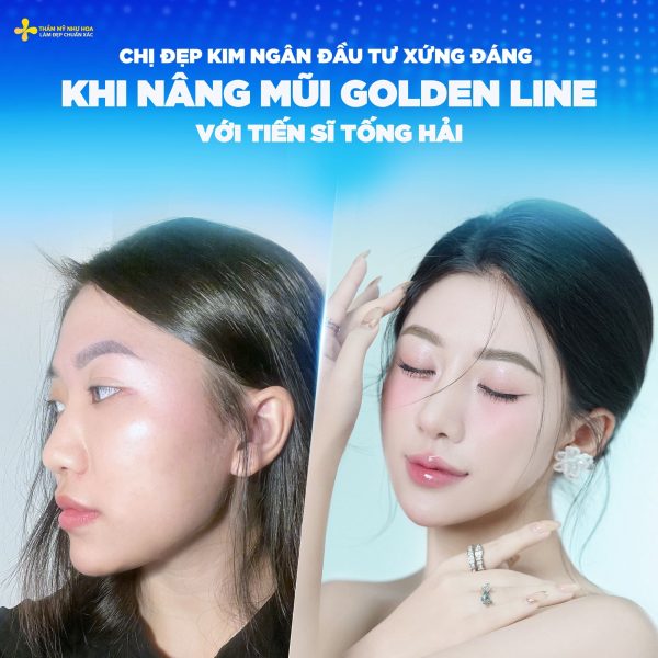 Nâng mũi bao lâu thì đầu mũi hết to? Cách giúp đầu mũi nhanh hết to 5 kim ngan he 1