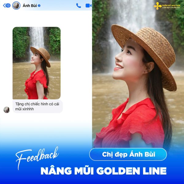 Nâng mũi bao lâu thì sinh hoạt bình thường? Giải đáp chi tiết từ chuyên gia thẩm mỹ 5 mui golden line 1