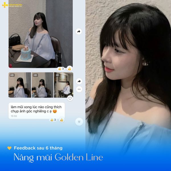Nâng mũi Golden Line: Công nghệ đỉnh cao cho dáng mũi chuẩn 10 nang mui he 1