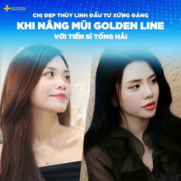 Nâng mũi bao lâu thì sinh hoạt bình thường? Giải đáp chi tiết từ chuyên gia thẩm mỹ 4 thuy linh 1
