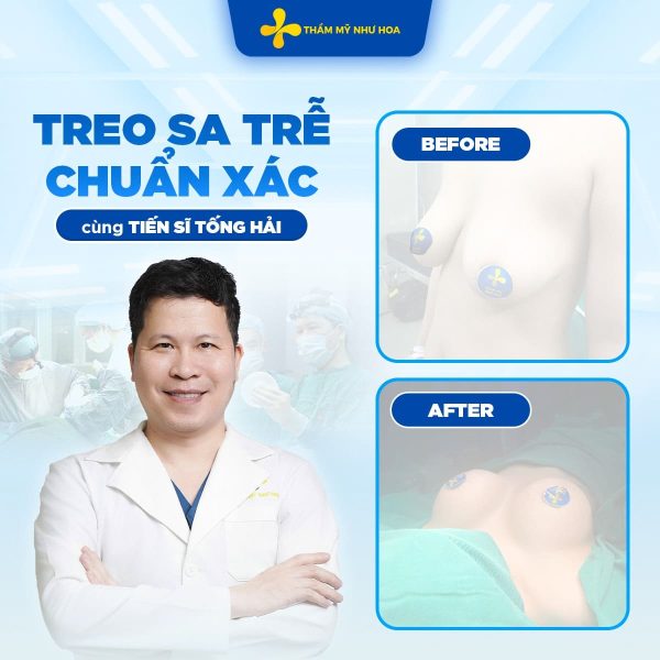 Treo sa trễ là gì? Các cấp độ treo ngực sa trễ bạn cần biết 8 6 1