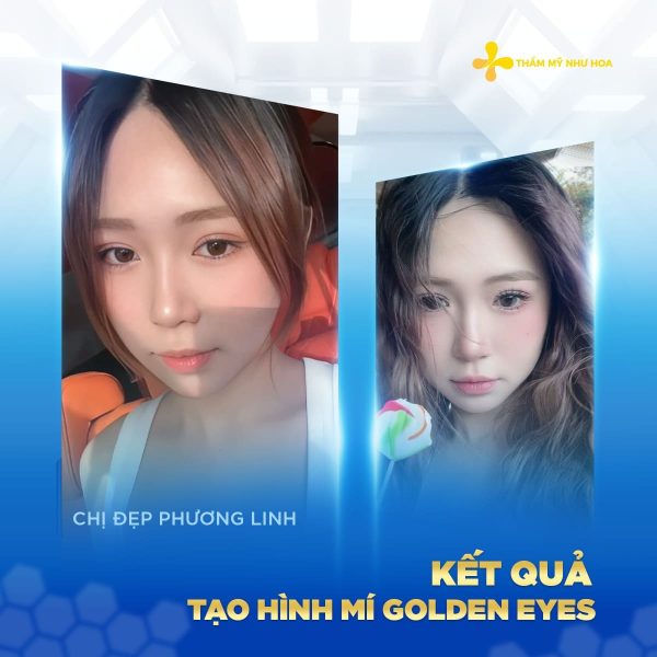 Cắt mí Golden Eyes bao lâu thì đẹp? Thời gian hồi phục và những điều cần biết 4 13 1