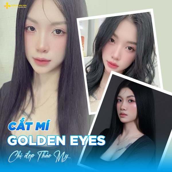 Review kết quả cắt mí Golden Eyes – Thực tế sau khi làm 6 thao my 1