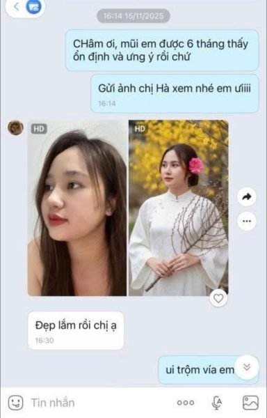 Vì sao bảo hành trọn đời chất liệu lại quan trọng khi làm mũi? 7 634197375 1359547656207132 7697499762235420885 n 1